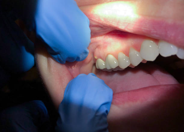 Best Emergency Treatment for Dental Infections or Abscesses in Farmers Branch, TX